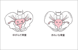 骨盤矯正